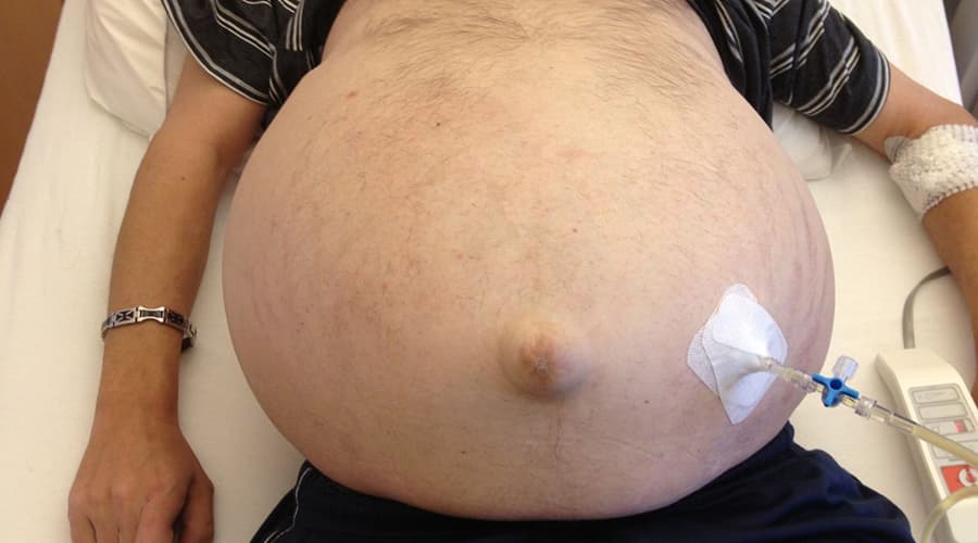 Paracentesis